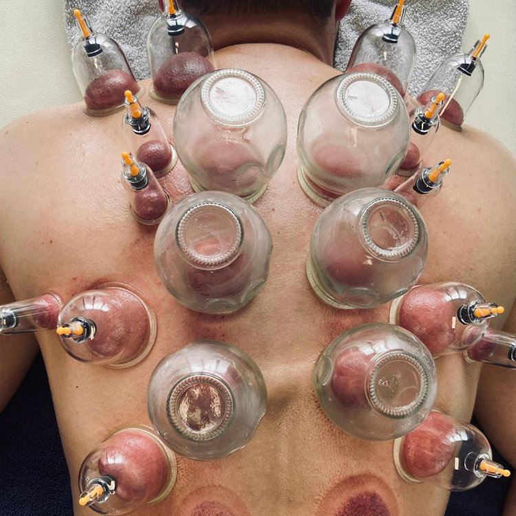 Cupping